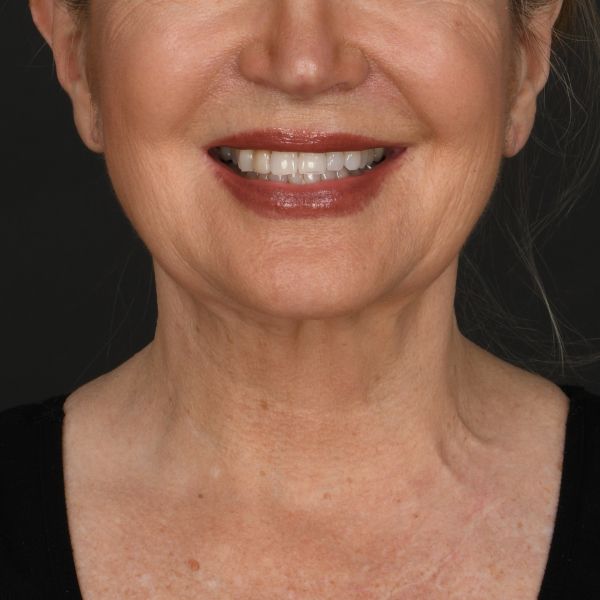 Neck Lift Before & After Image