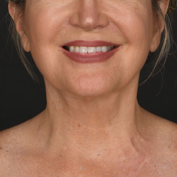 Neck Lift Before & After Image