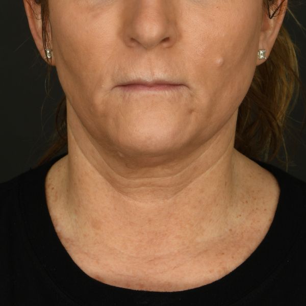 Neck lift Before & After Image
