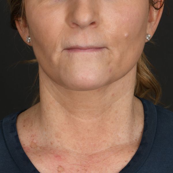 Neck lift Before & After Image