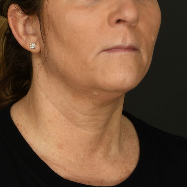 Neck lift Before & After Image