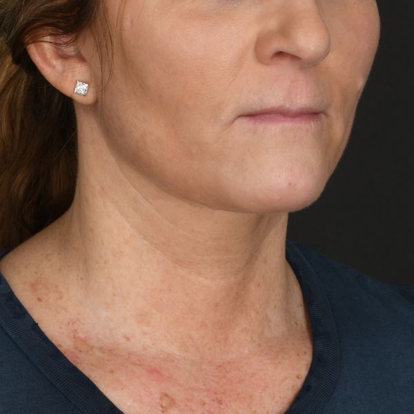 Neck lift Before & After Image