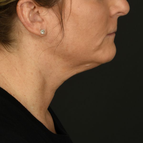 Neck Lift Before & After Image