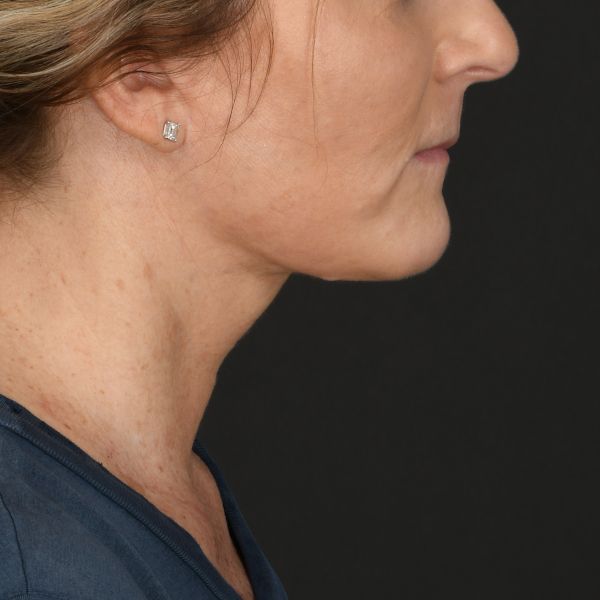 Neck Lift Before & After Image