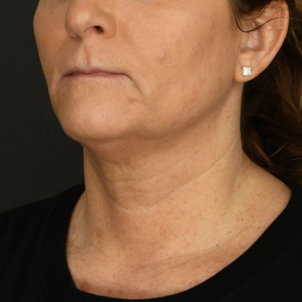 Neck Lift Before & After Image