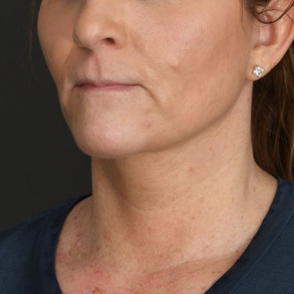 Neck Lift Before & After Image