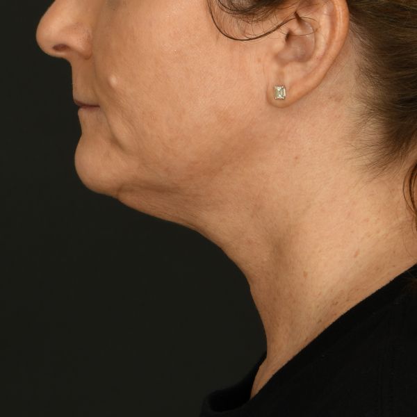 Neck Lift Before & After Image