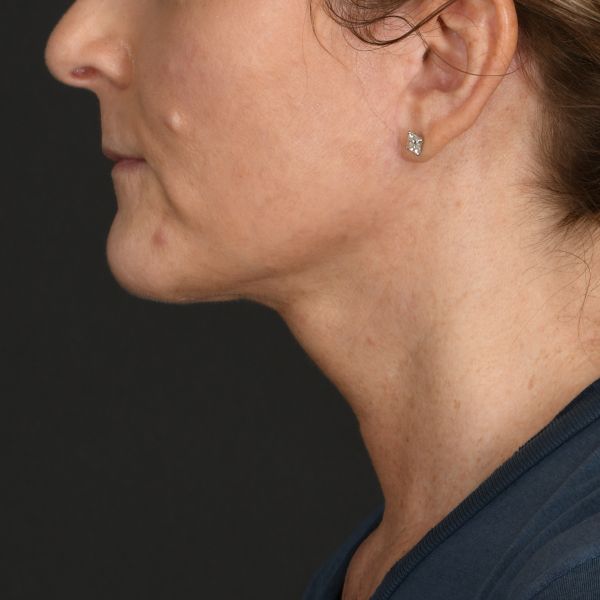 Neck Lift Before & After Image