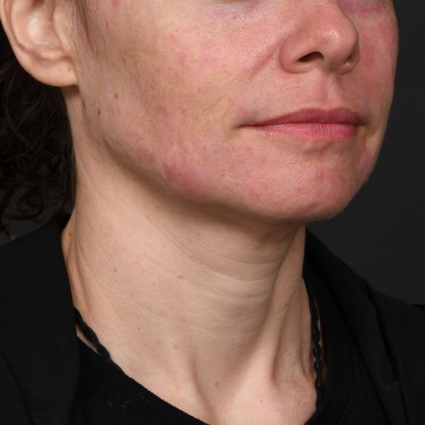 Neck lift Before & After Image