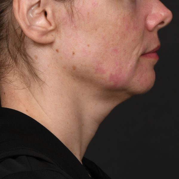 Neck lift Before & After Image