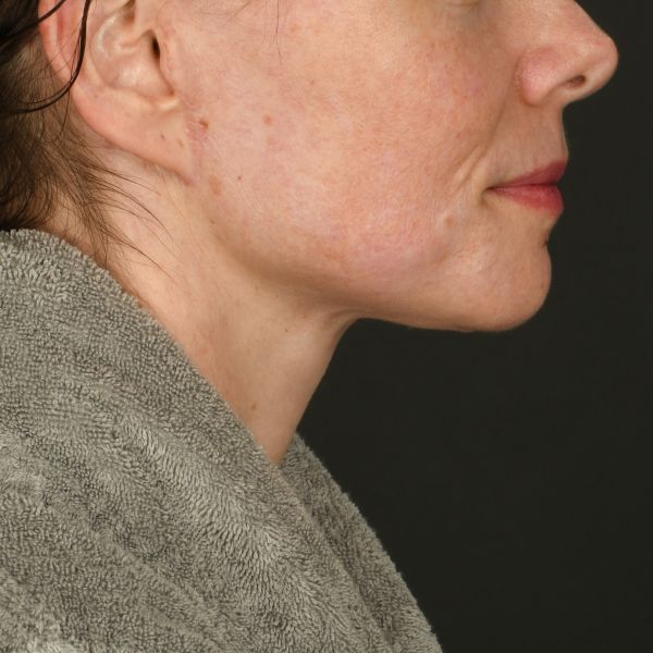Neck lift Before & After Image