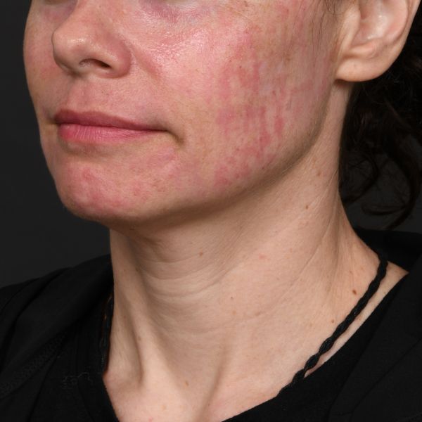 Neck Lift Before & After Image