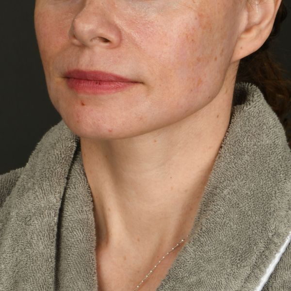 Neck Lift Before & After Image