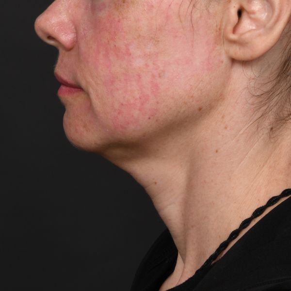 Neck Lift Before & After Image