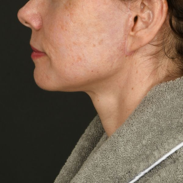 Neck Lift Before & After Image