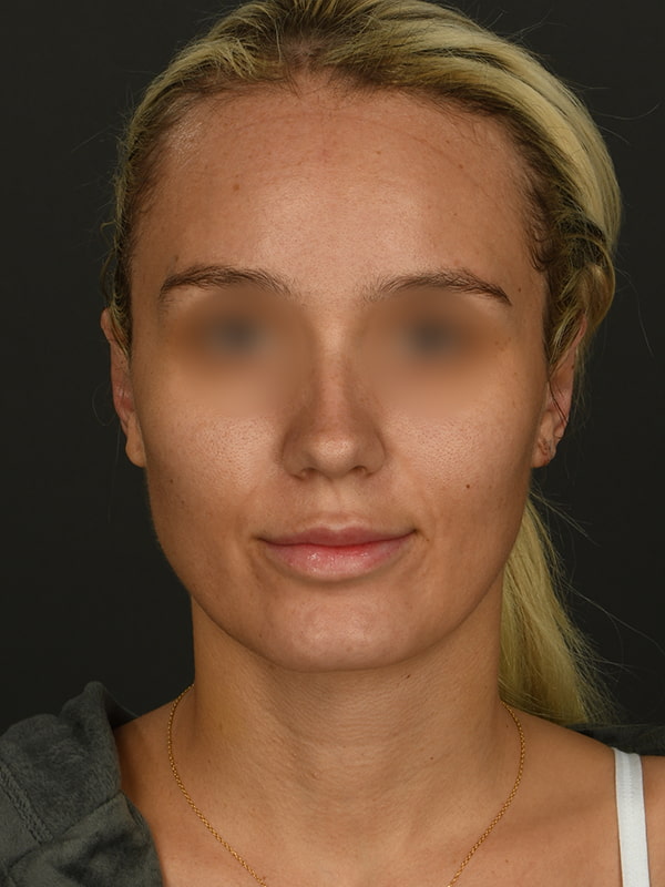 Otoplasty Before & After Image