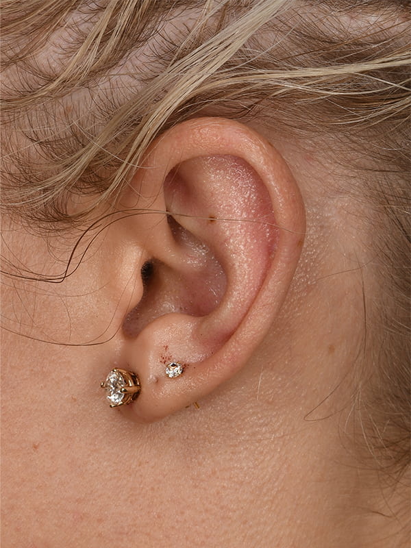 Otoplasty Before & After Image