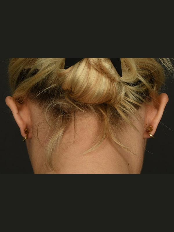Otoplasty Before & After Image