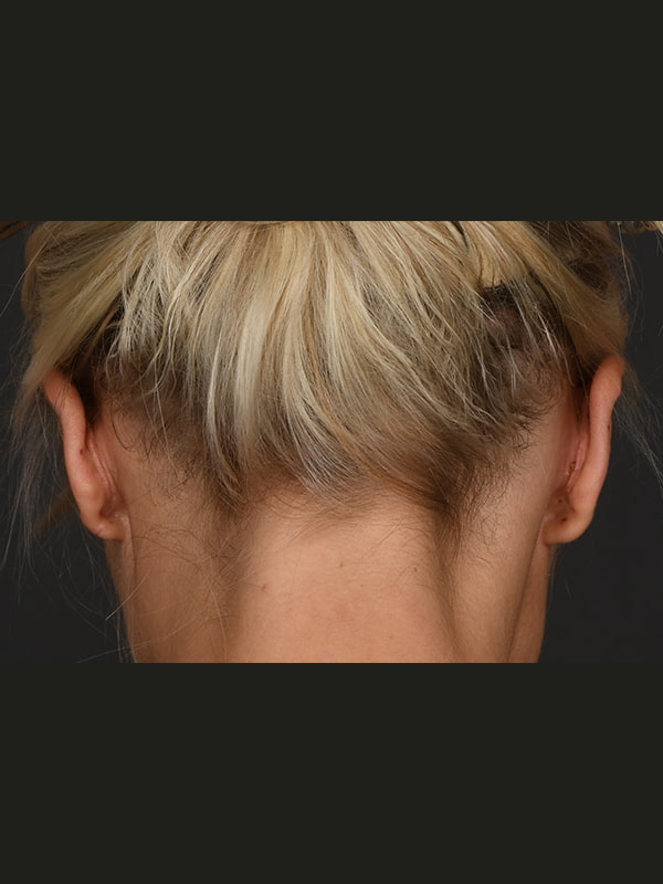 Otoplasty Before & After Image