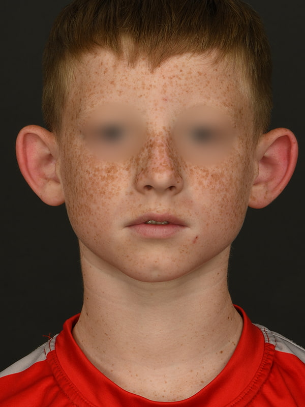 Otoplasty Before & After Image