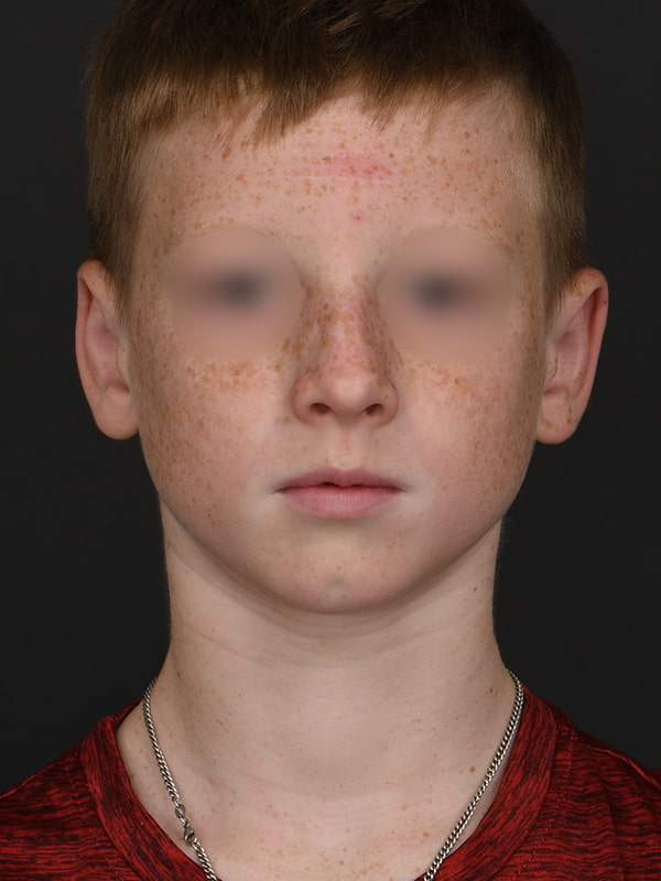 Otoplasty Before & After Image
