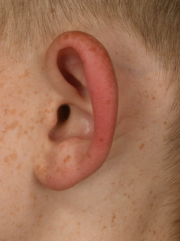 Otoplasty Before & After Image