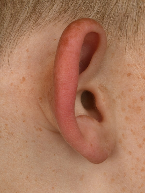 Otoplasty Before & After Image