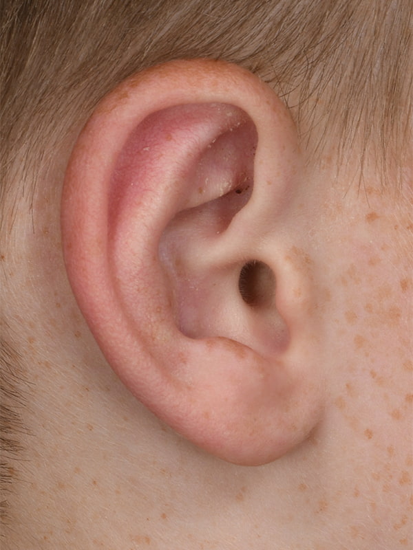 Otoplasty Before & After Image
