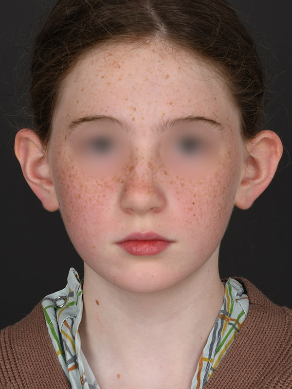 Otoplasty Before & After Image