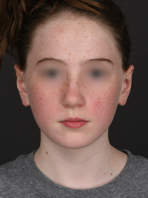 Otoplasty Before & After Image