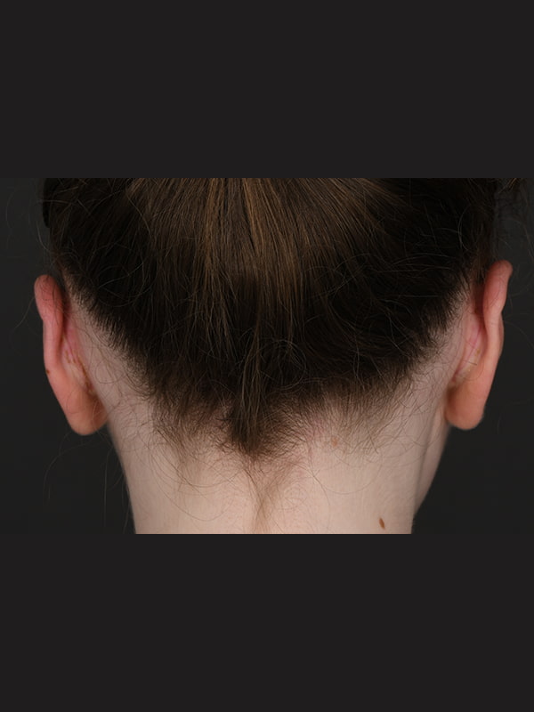 Otoplasty Before & After Image