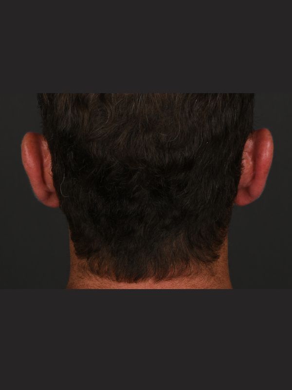 Otoplasty Before & After Image