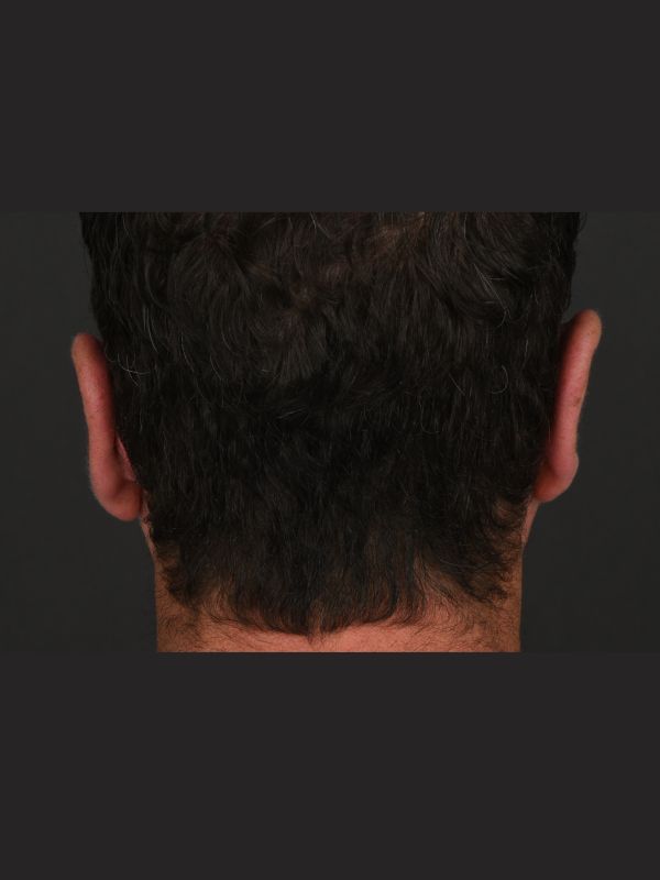 Otoplasty Before & After Image