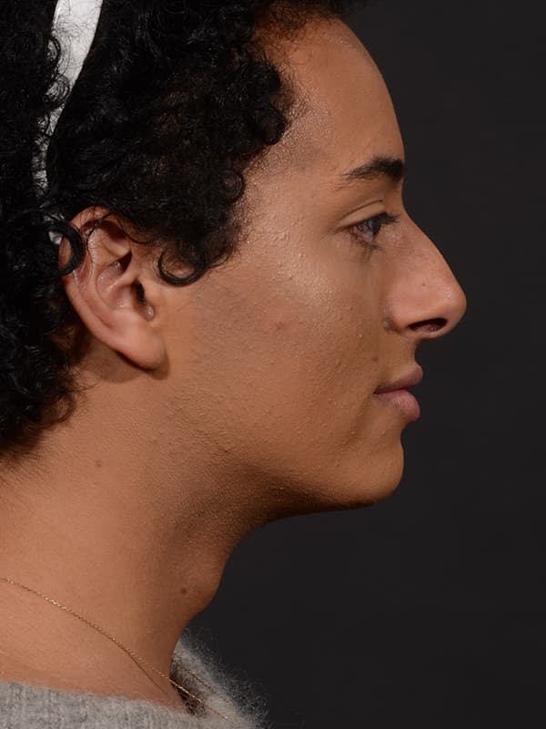 Rhinoplasty Before & After Image