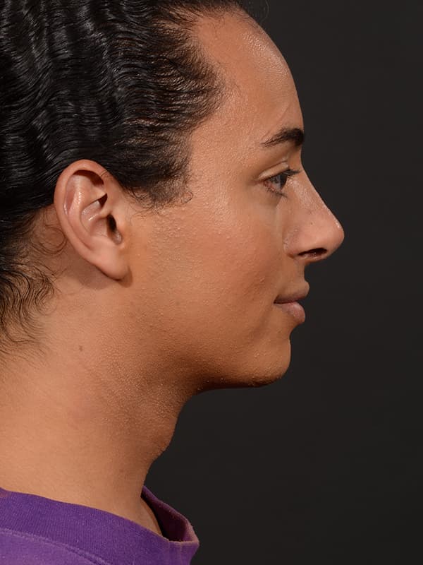 Rhinoplasty Before & After Image