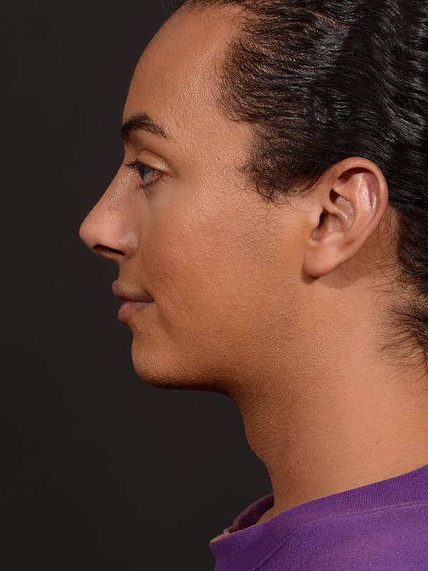 Rhinoplasty Before & After Image