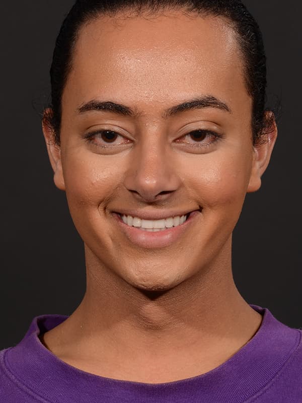 Rhinoplasty Before & After Image