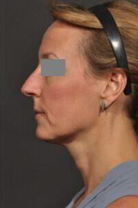 Rhinoplasty Before & After Image