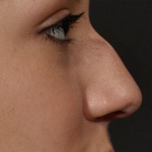 Rhinoplasty Before & After Image