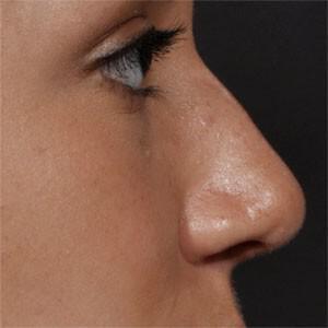 Rhinoplasty Before & After Image