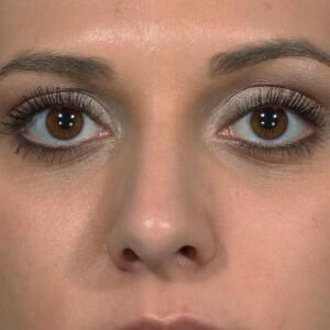 Rhinoplasty Before & After Image