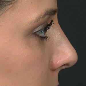 Rhinoplasty Before & After Image