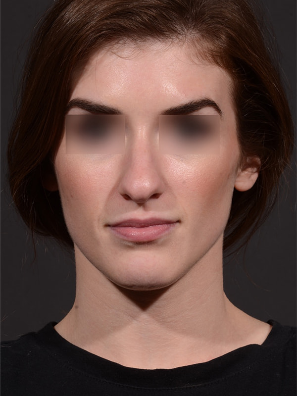 Rhinoplasty Before & After Image