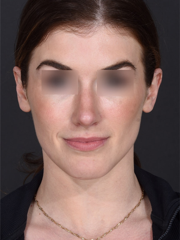 Rhinoplasty Before & After Image