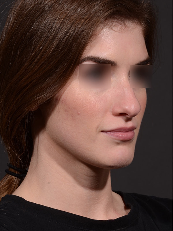 Rhinoplasty Before & After Image