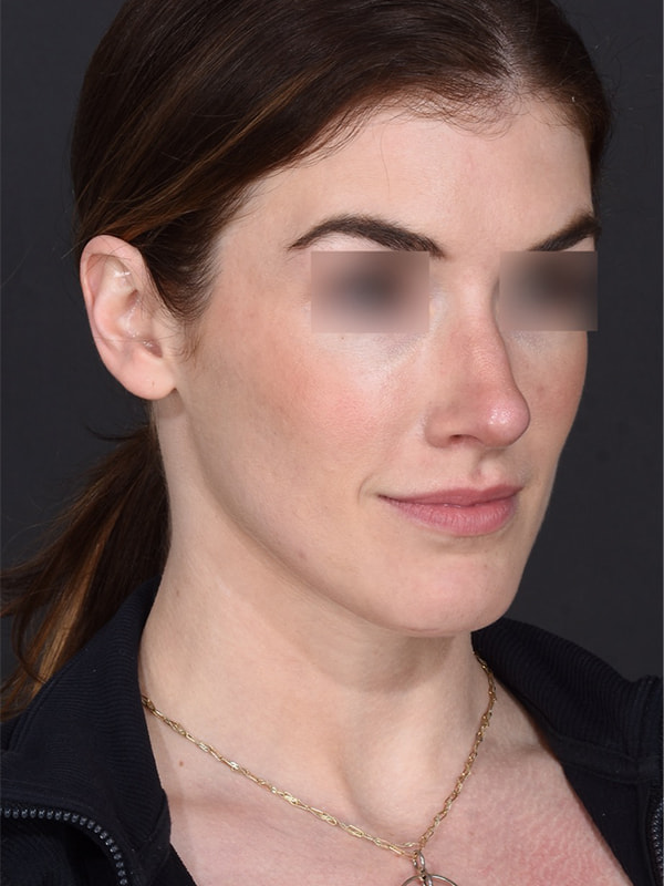 Rhinoplasty Before & After Image