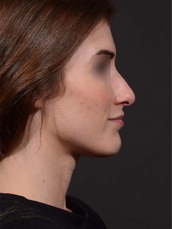 Rhinoplasty Before & After Image