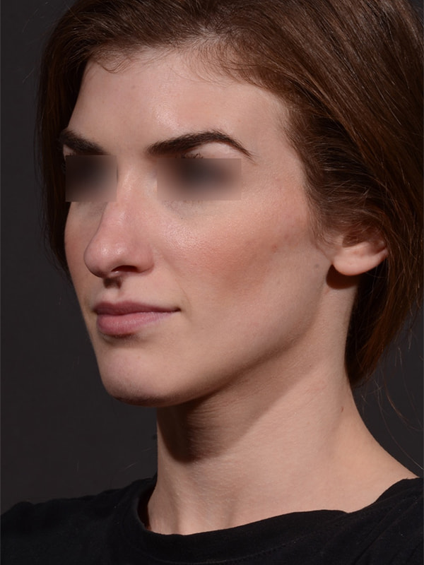 Rhinoplasty Before & After Image