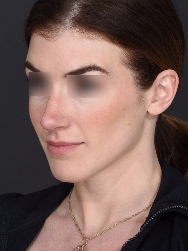 Rhinoplasty Before & After Image