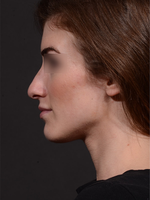 Rhinoplasty Before & After Image